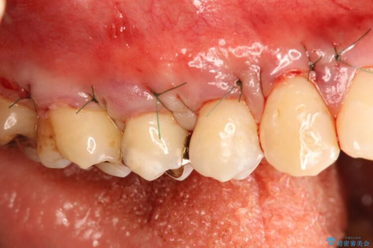 【40代】歯茎の再生治療で知覚過敏を治す 治療途中画像