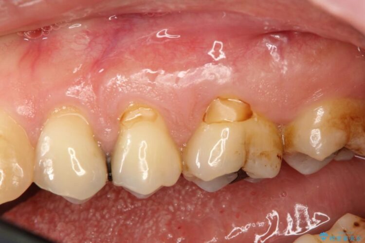 【40代】歯茎の再生治療で知覚過敏を治す 治療前画像