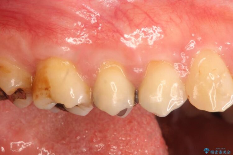 【40代】歯茎の再生治療で知覚過敏を治す 治療後画像