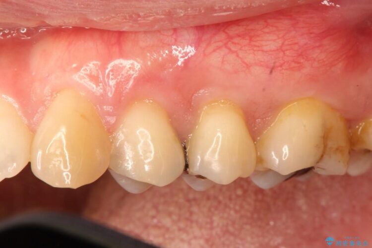 【40代】歯茎の再生治療で知覚過敏を治す 治療後画像