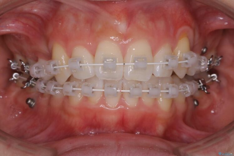【20代女性】可能な限り少ない抜歯で飛び出た八重歯のないきれいな歯並びに 治療途中画像