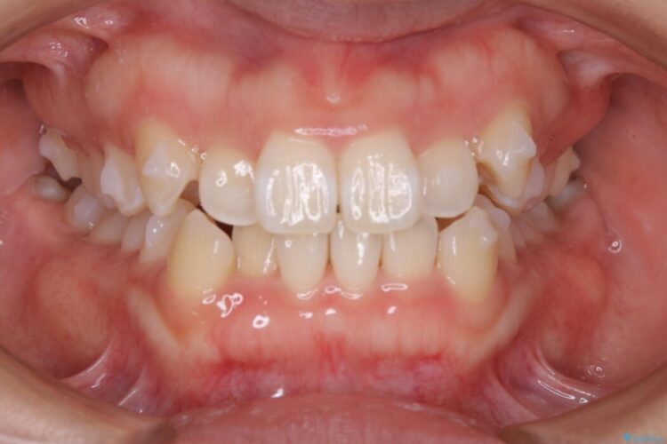 【20代女性】がたがたしている歯並びをインビザラインで矯正 治療途中画像