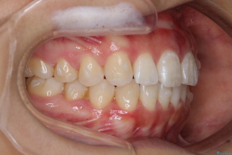 【20代女性】前歯の隙間を閉じたい 治療途中画像