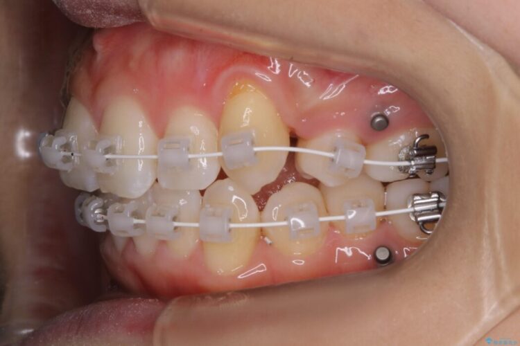 【20代女性】可能な限り少ない抜歯で飛び出た八重歯のないきれいな歯並びに 治療途中画像