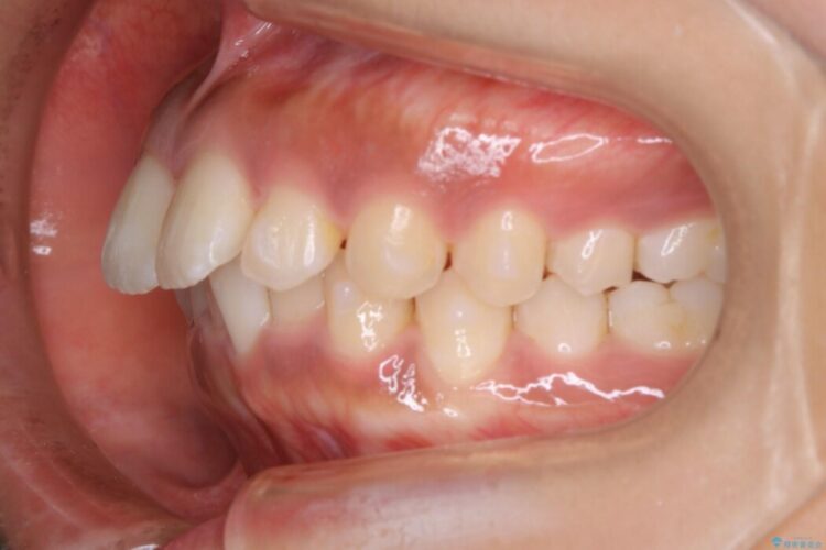 【20代女性】抜歯無しで出っ歯をなおすインビザライン矯正 治療途中画像