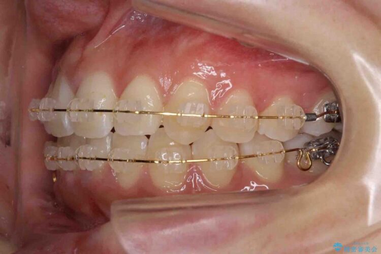 【20代女性】歯を抜かずに前歯のがたがたを矯正治療 治療途中画像