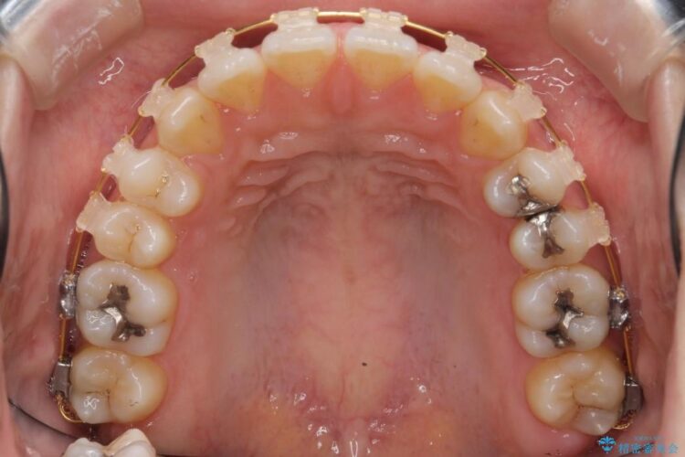 【20代女性】抜歯無しですきっ歯の矯正治療 治療途中画像