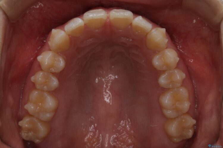 【20代女性】前歯の隙間を閉じたい 治療途中画像