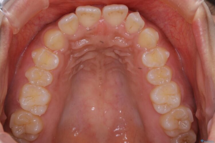 【20代女性】抜歯無しで出っ歯をなおすインビザライン矯正 治療途中画像