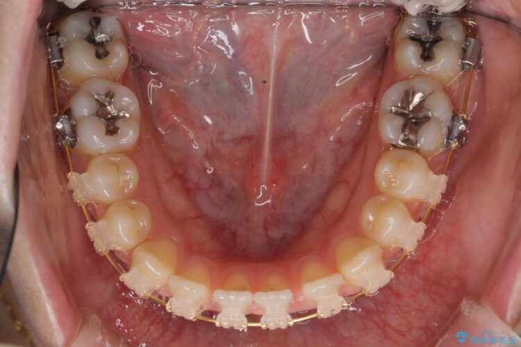 【20代女性】抜歯無しですきっ歯の矯正治療 治療途中画像
