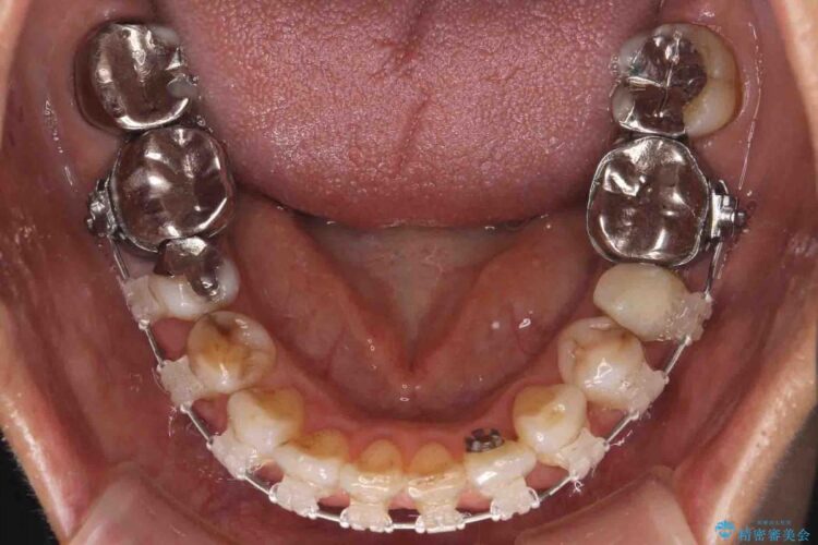 【60代女性】前歯のがたがたを矯正治療 治療途中画像