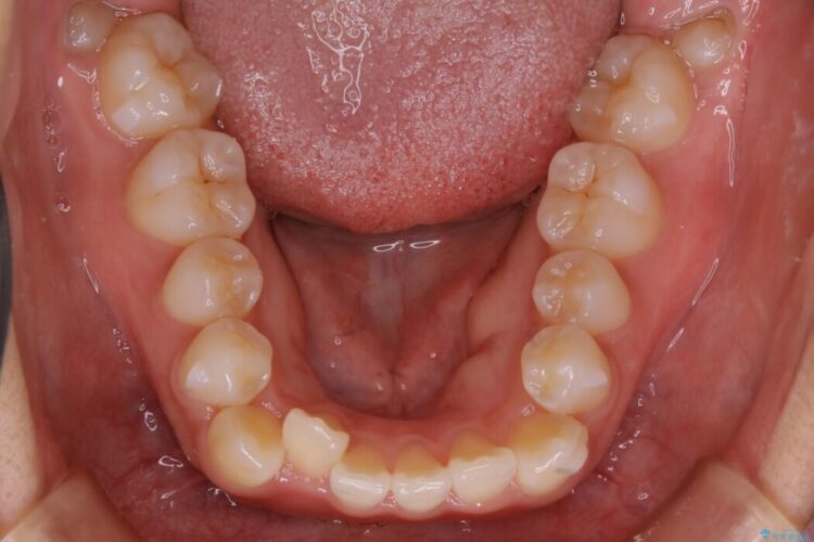 【20代女性】がたがたしている歯並びをインビザラインで矯正 治療途中画像