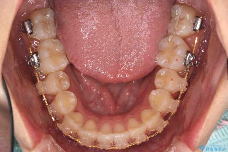 【20代女性】歯を抜かずに前歯のがたがたを矯正治療 治療途中画像