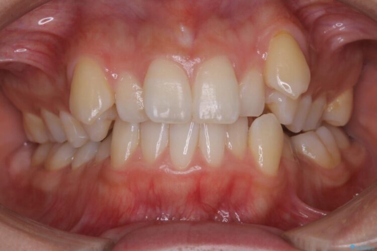 【20代女性】可能な限り少ない抜歯で飛び出た八重歯のないきれいな歯並びに 治療前画像