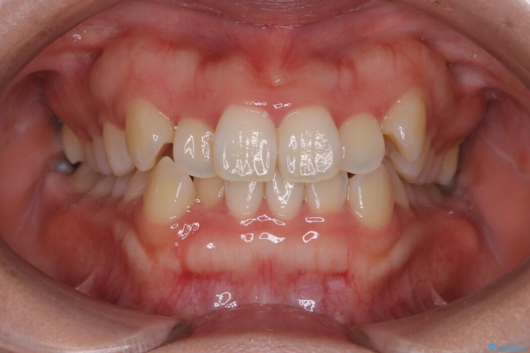 【20代女性】がたがたしている歯並びをインビザラインで矯正 治療前