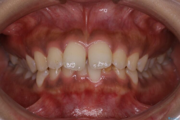 【20代女性】抜歯無しで出っ歯をなおすインビザライン矯正 治療前画像