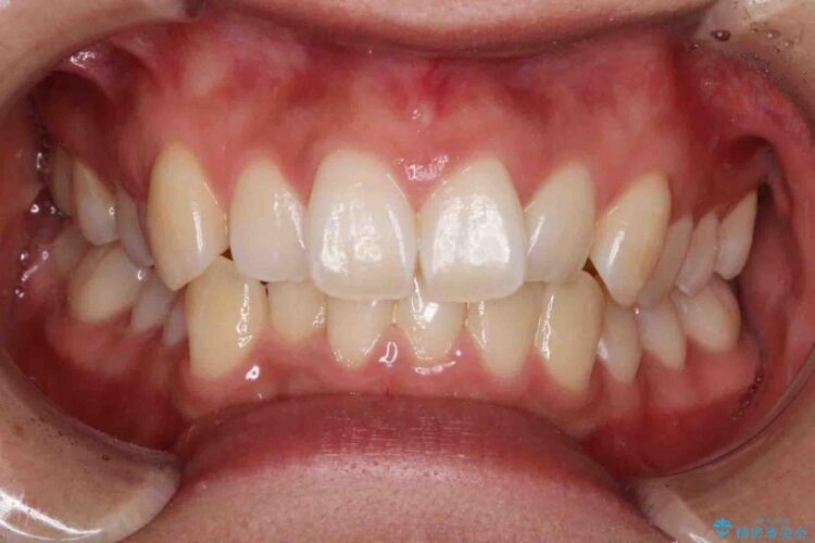 【20代女性】歯を抜かずに前歯のがたがたを矯正治療 ビフォー
