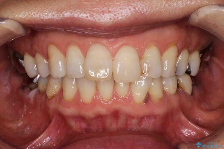 【60代女性】前歯のがたがたを矯正治療 ビフォー