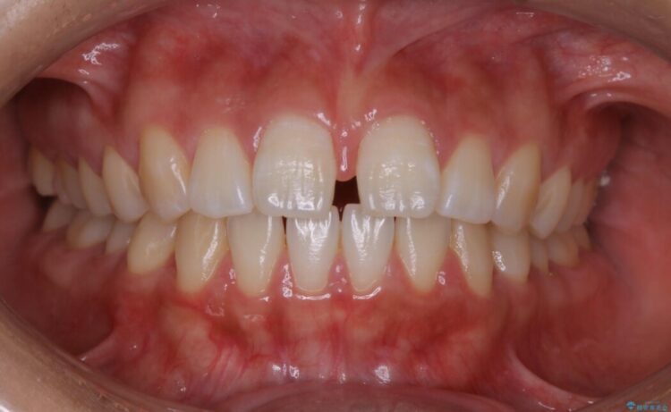 【20代女性】前歯の隙間を閉じたい 治療前画像
