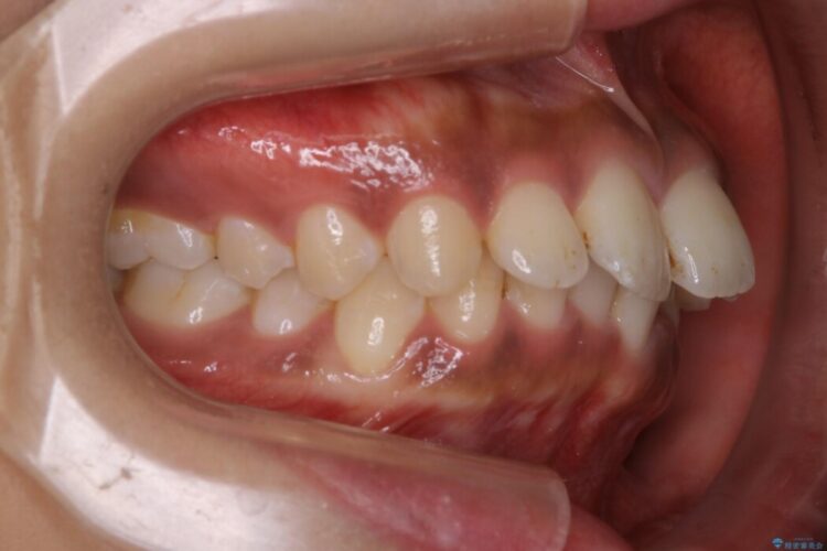 【20代女性】抜歯無しで出っ歯をなおすインビザライン矯正 治療前画像