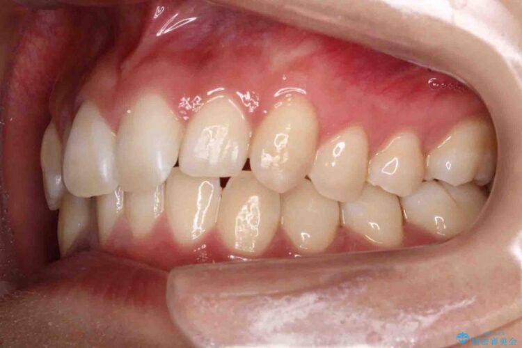 【20代女性】歯を抜かずに前歯のがたがたを矯正治療 治療前画像