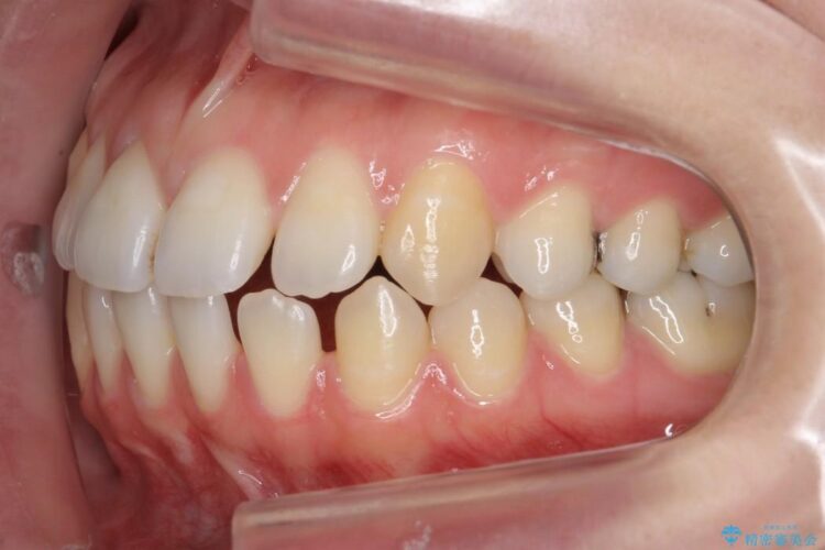 【20代女性】抜歯無しですきっ歯の矯正治療 治療前画像