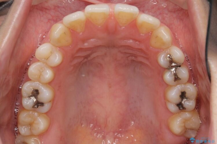 【20代女性】抜歯無しですきっ歯の矯正治療 治療前画像