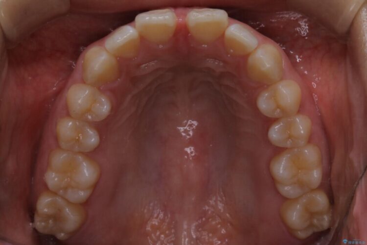 【20代女性】前歯の隙間を閉じたい 治療前画像