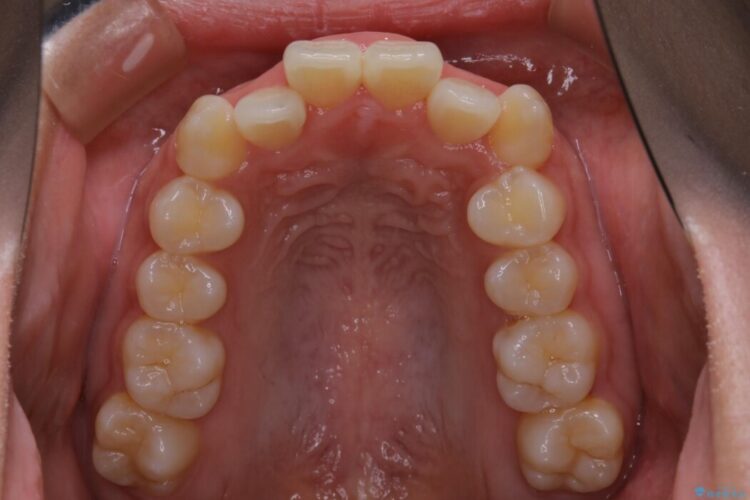 【20代女性】がたがたしている歯並びをインビザラインで矯正 治療前画像