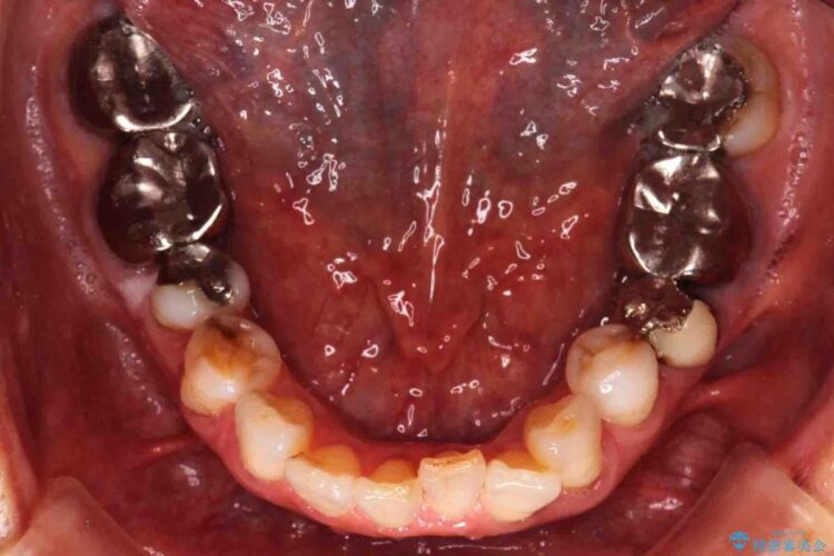 【60代女性】前歯のがたがたを矯正治療 治療前画像