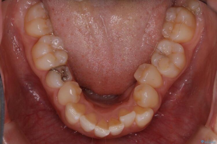 【20代女性】可能な限り少ない抜歯で飛び出た八重歯のないきれいな歯並びに 治療前画像