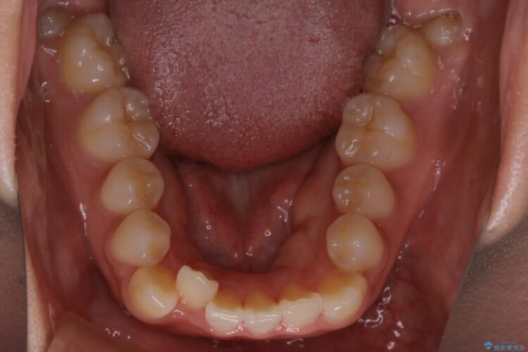 【20代女性】がたがたしている歯並びをインビザラインで矯正 治療前画像