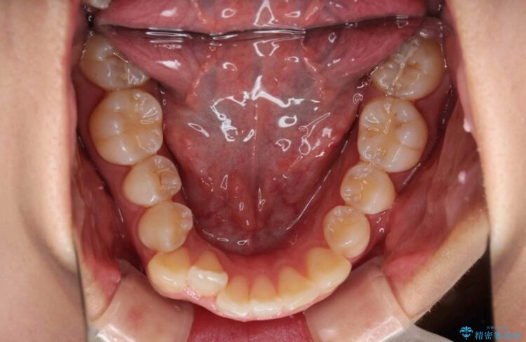【20代女性】歯を抜かずに前歯のがたがたを矯正治療 治療前画像