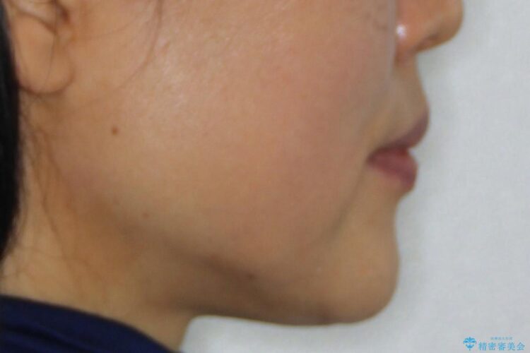 【60代女性】前歯のがたがたを矯正治療 治療前画像