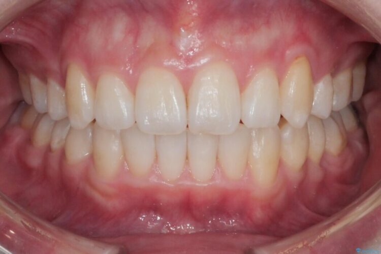 【20代女性】可能な限り少ない抜歯で飛び出た八重歯のないきれいな歯並びに アフター