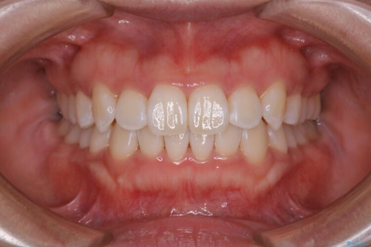 【20代女性】がたがたしている歯並びをインビザラインで矯正 治療後画像