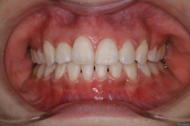 【20代女性】オフィスホワイトニングで歯を白くする 治療後画像