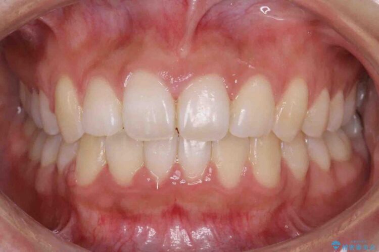 【20代女性】歯を抜かずに前歯のがたがたを矯正治療 アフター