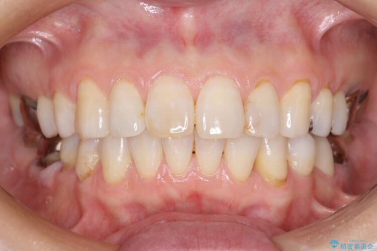 【60代女性】前歯のがたがたを矯正治療 アフター