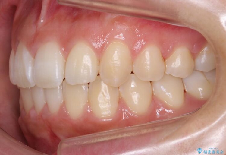 【20代女性】歯を抜かずに前歯のがたがたを矯正治療 治療後画像