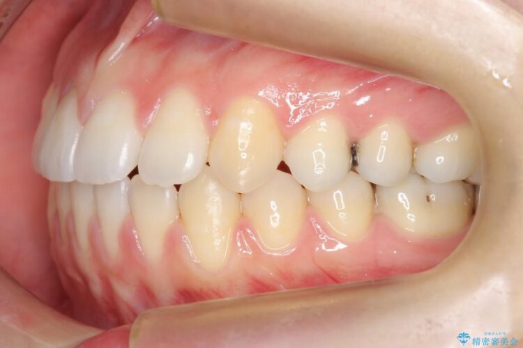 【20代女性】抜歯無しですきっ歯の矯正治療 治療後画像