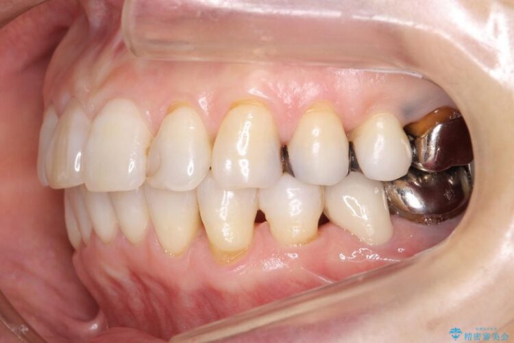 【60代女性】前歯のがたがたを矯正治療 治療後画像