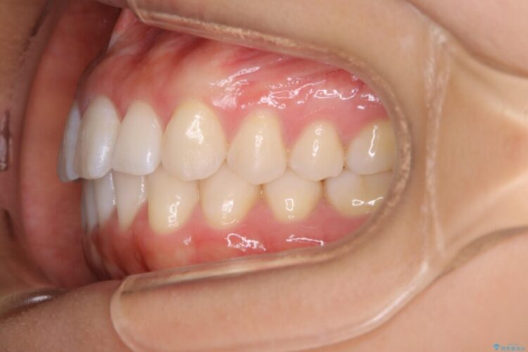 【20代女性】前歯の隙間を閉じたい 治療後画像