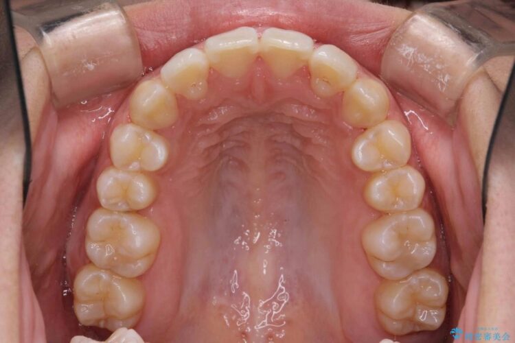 【20代女性】歯を抜かずに前歯のがたがたを矯正治療 治療後画像