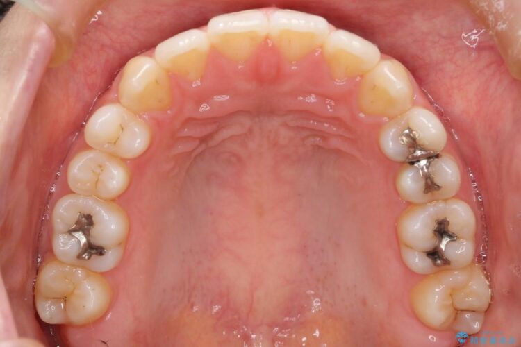 【20代女性】抜歯無しですきっ歯の矯正治療 治療後画像