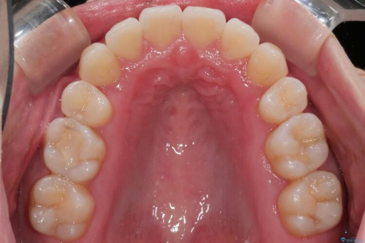【20代女性】可能な限り少ない抜歯で飛び出た八重歯のないきれいな歯並びに 治療後画像