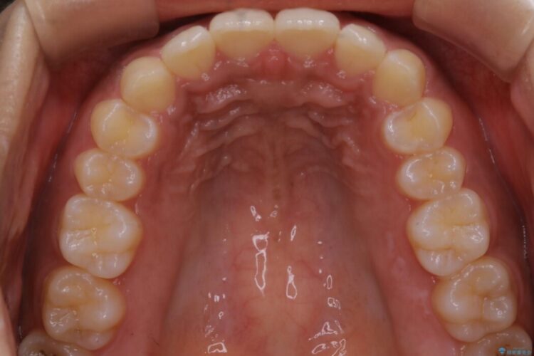 【20代女性】抜歯無しで出っ歯をなおすインビザライン矯正 治療後画像