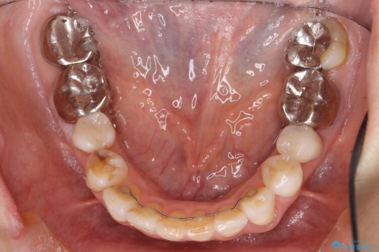 【60代女性】前歯のがたがたを矯正治療 治療後画像