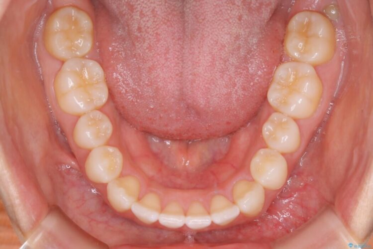 【20代女性】前歯の隙間を閉じたい 治療後画像