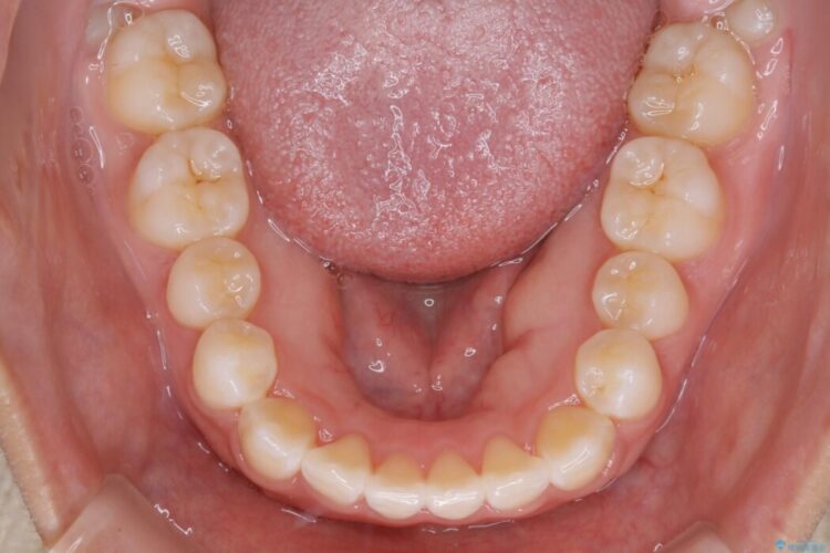 【20代女性】がたがたしている歯並びをインビザラインで矯正 治療後画像